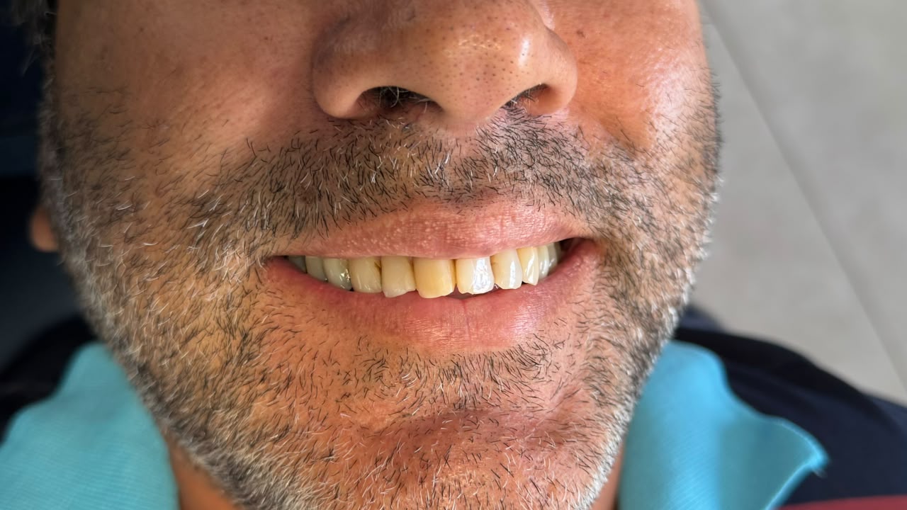 Sorriso do paciente antes do tratamento reabilitador